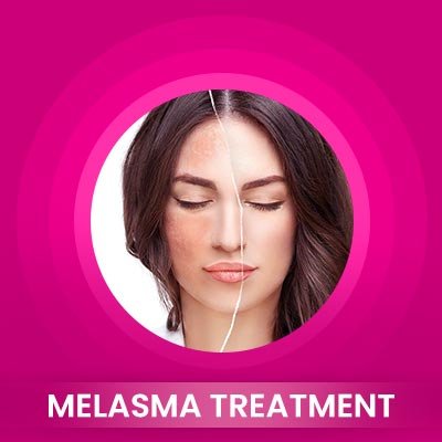 Melasma Treatment