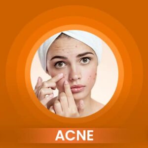 ACNE-300x300
